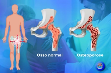 Prevenção antes da fratura: Osteoporose e Osteopenia
