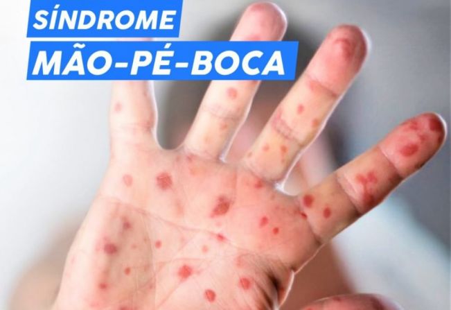 Saúde de Paraguaçu enfrenta surto da síndrome ‘mão-pé-boca’
