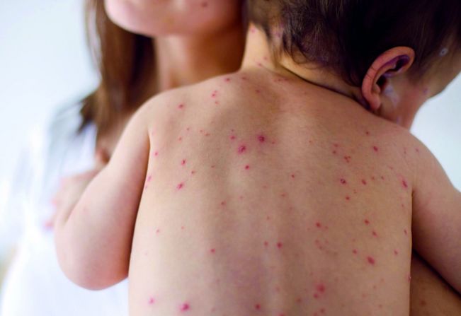 SARAMPO: crianças que se deslocarem para municípios em situação de risco devem ser vacinadas