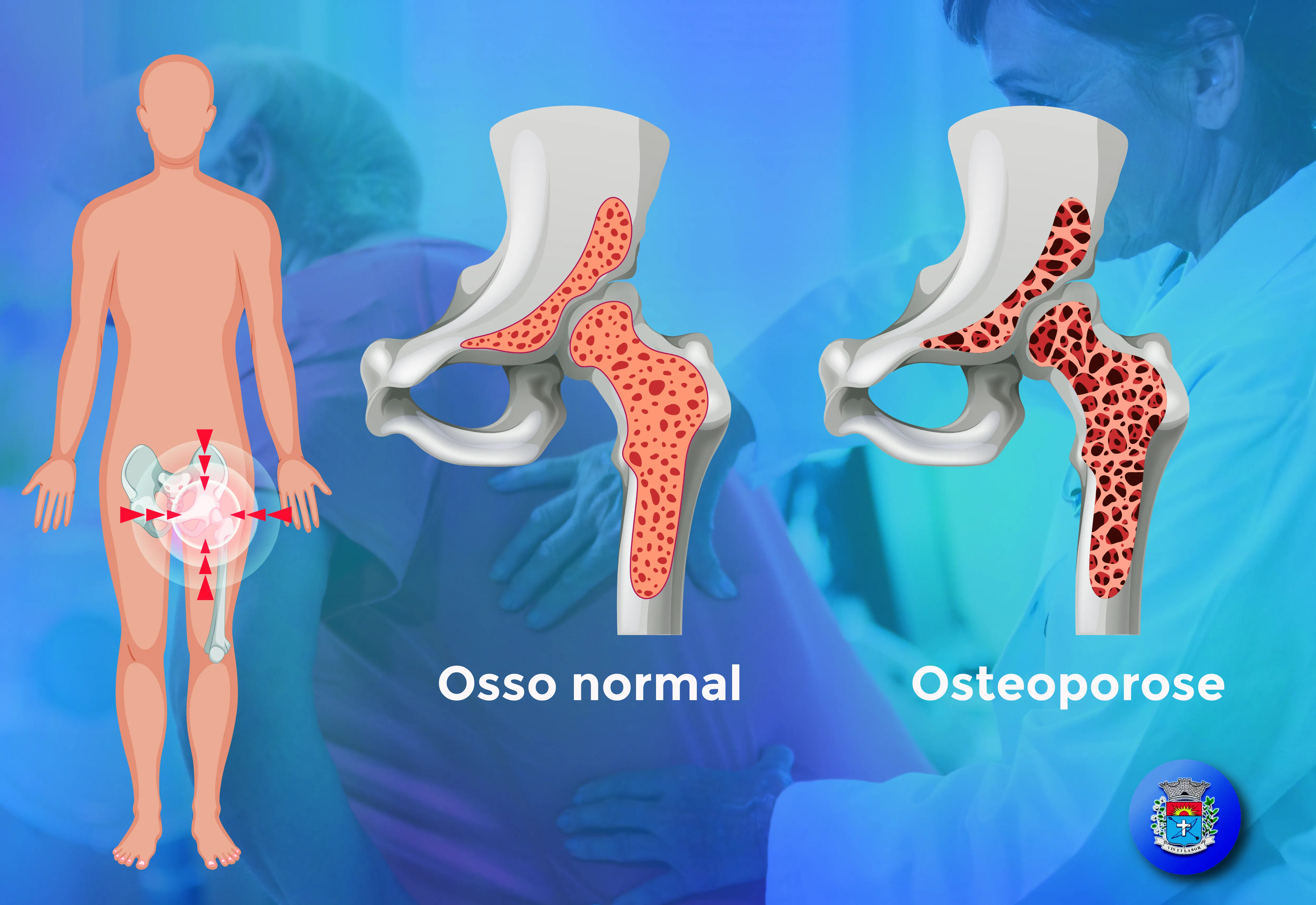 Prevenção antes da fratura: Osteoporose e Osteopenia