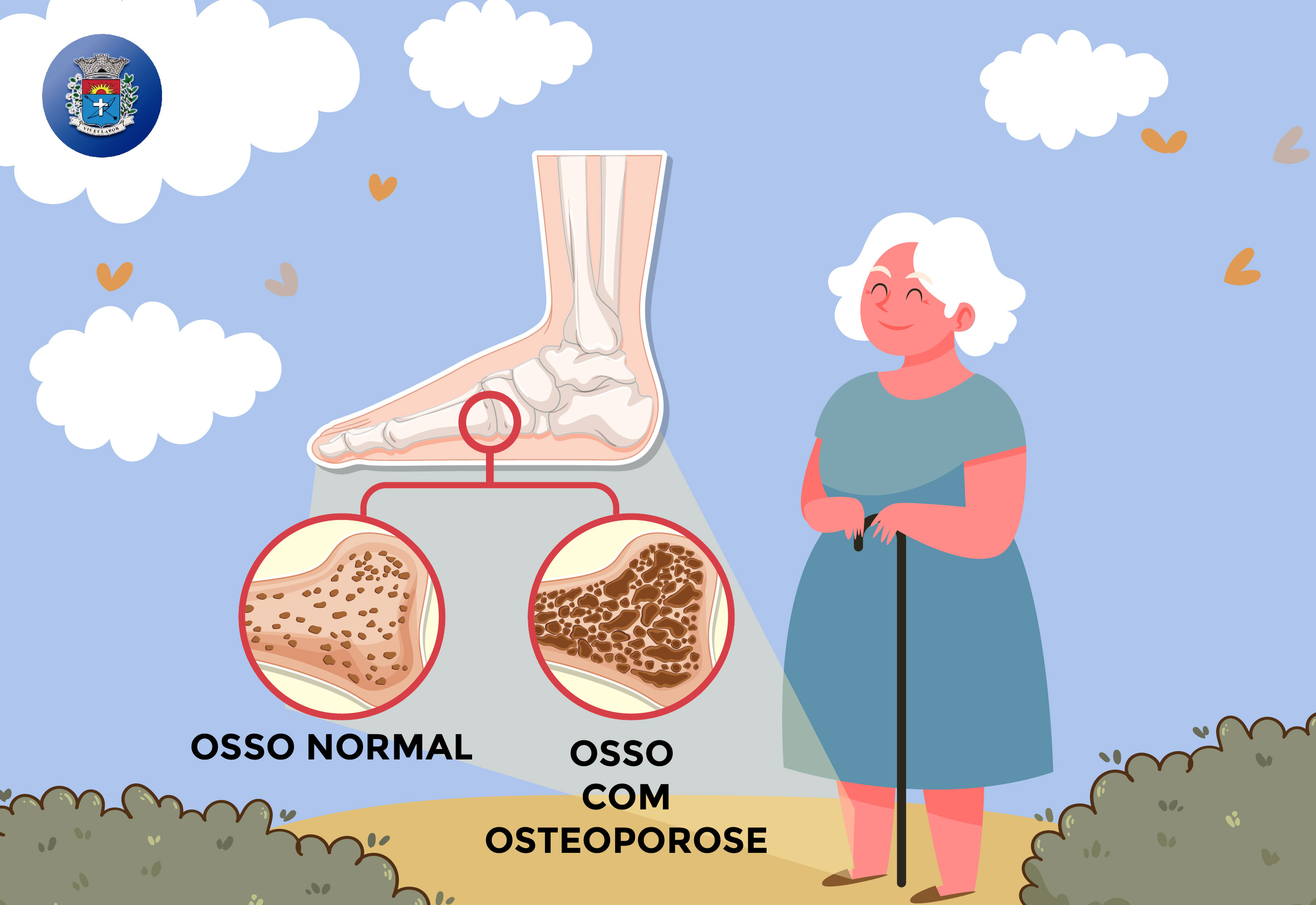 Osteoporose e Osteopenia: A Prevenção Começa Antes da Fratura