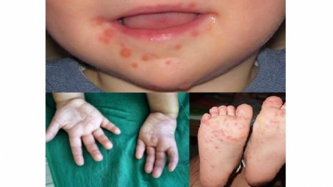 Saúde e Educação de Paraguaçu se mobilizam contra a Síndrome Mão-Pé-Boca